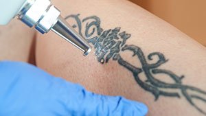 How to Remove Fresh Tattoo Ink From Skin