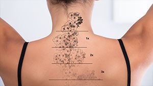remove-permanent-tattoo-without-laser